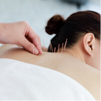 Acupuncture