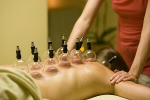 cupping therapy