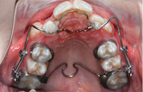 braces during b