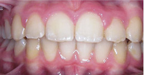 braces-2-after