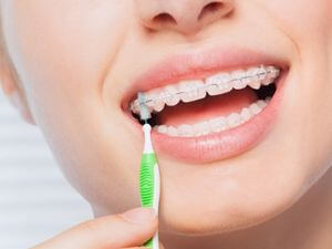 braces