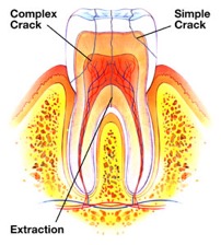 Endodontist London: Common Dental Problems They Treat 3 Cracked Tooth Syndrome | Vision Dental