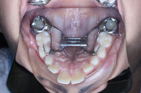 mid-treatment-after
