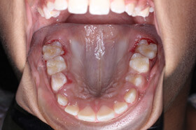midtreatment-before-after
