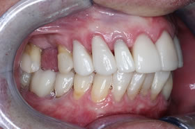 veneers 3 after right side