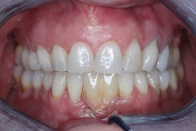 whitening case3 after1