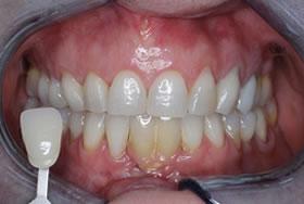 whitening case3 after2