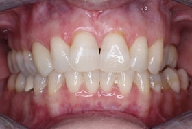 whitening case4 after1