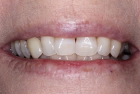 whitening case4 after3