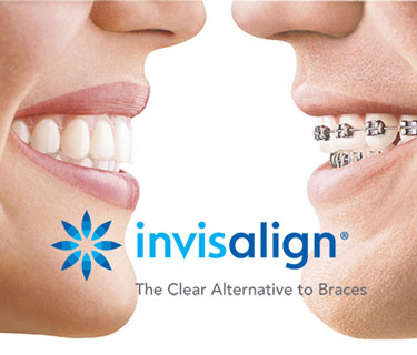 Are invisible braces the right solution for me? - Binder Family Dental