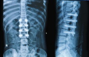 What happens after spinal fusion? The areas above and below the fusion carry exponentially more stress!