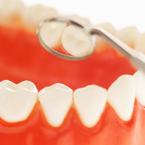 Fillings in Mt Lawley