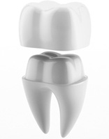 image of dental crown Dental crowns Mt Lawley
