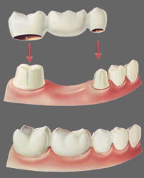 Illustration of dental bridge dental bridge perth