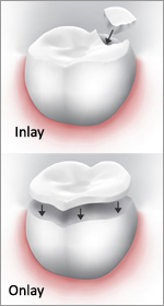 Mt Lawley dental Inlays onlays