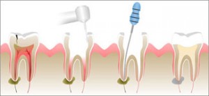 Root canal treatment