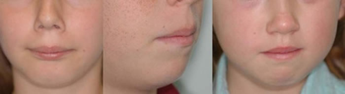 muscle used chin to bring lips together