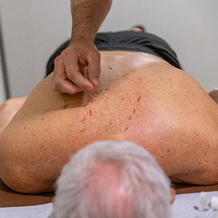 Applying acupuncture to back