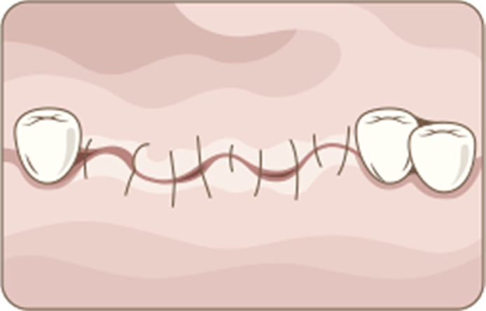 Conventional Dental Implant