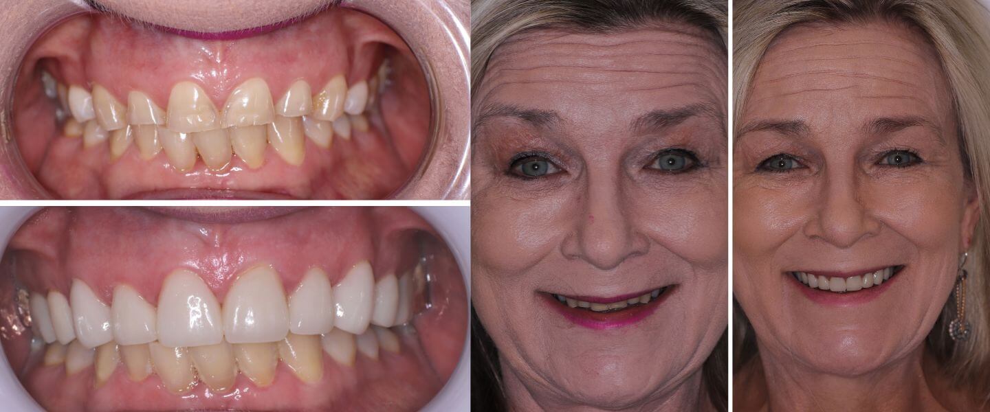 Helena before and after smiles