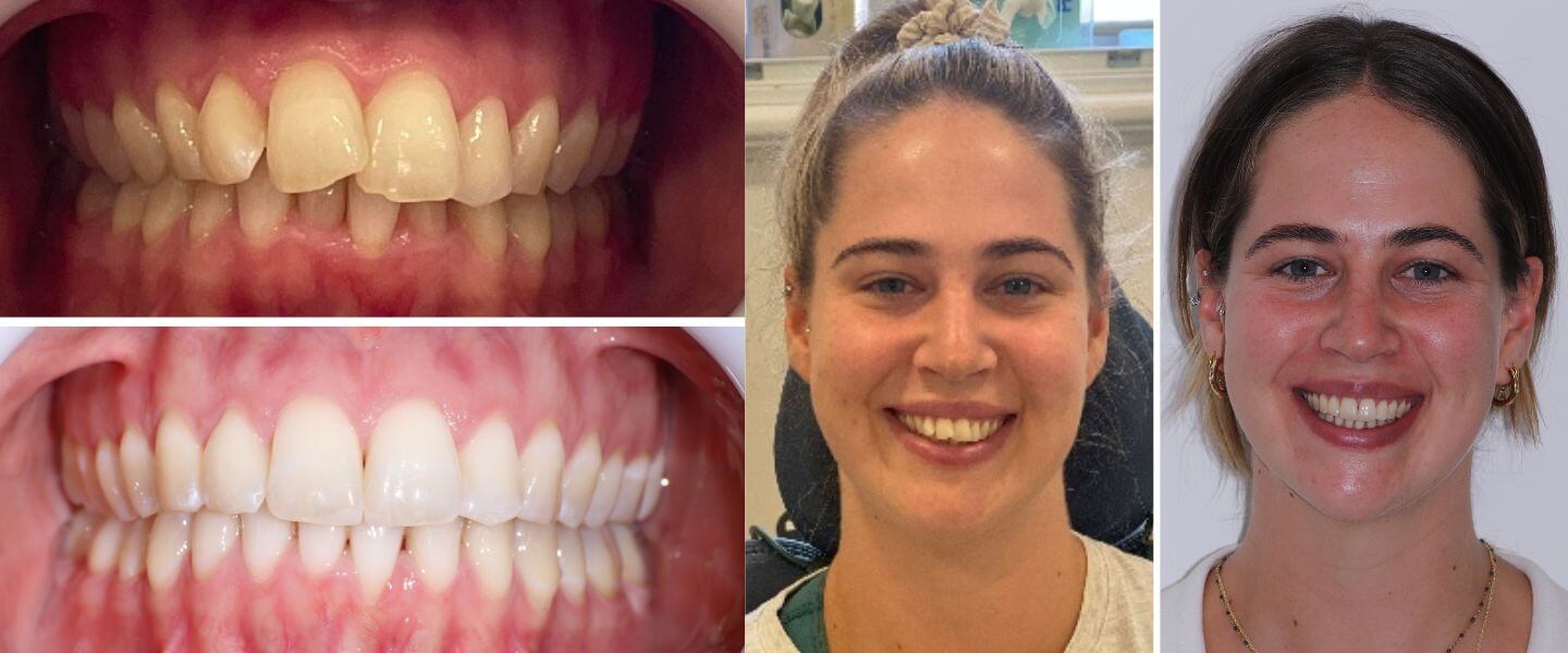 Shannon before and after smiles