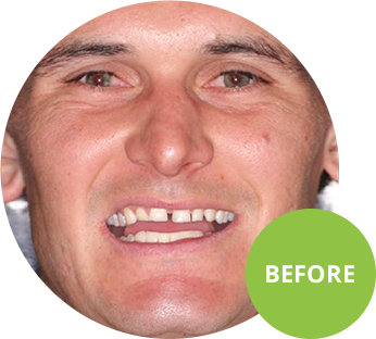 before digital smile design