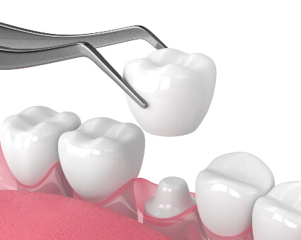 Illustration of a dental crown