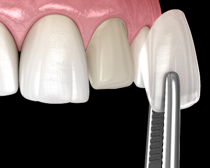 Dental Veneers illustration