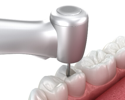 Root Canal Treatment illustration