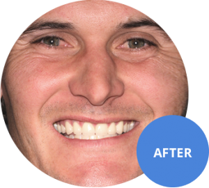 after digital smile design