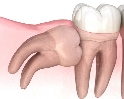 Wisdom Tooth Extraction illustration