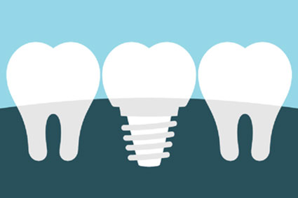 illustration of an implant