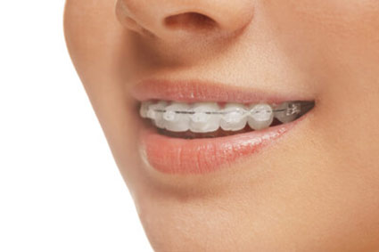 person with ceramic braces on their teeth
