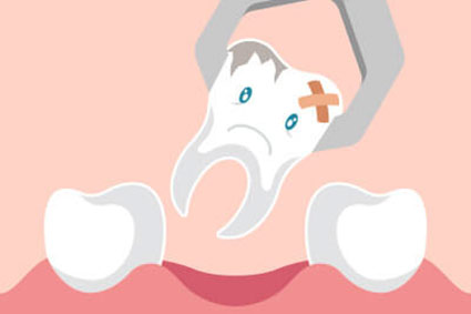 illustration of a tooth being extracted
