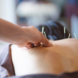 Acupuncture in back