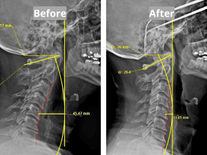 cadence-chiropractic-neck-posture-before-after-eden-prairie