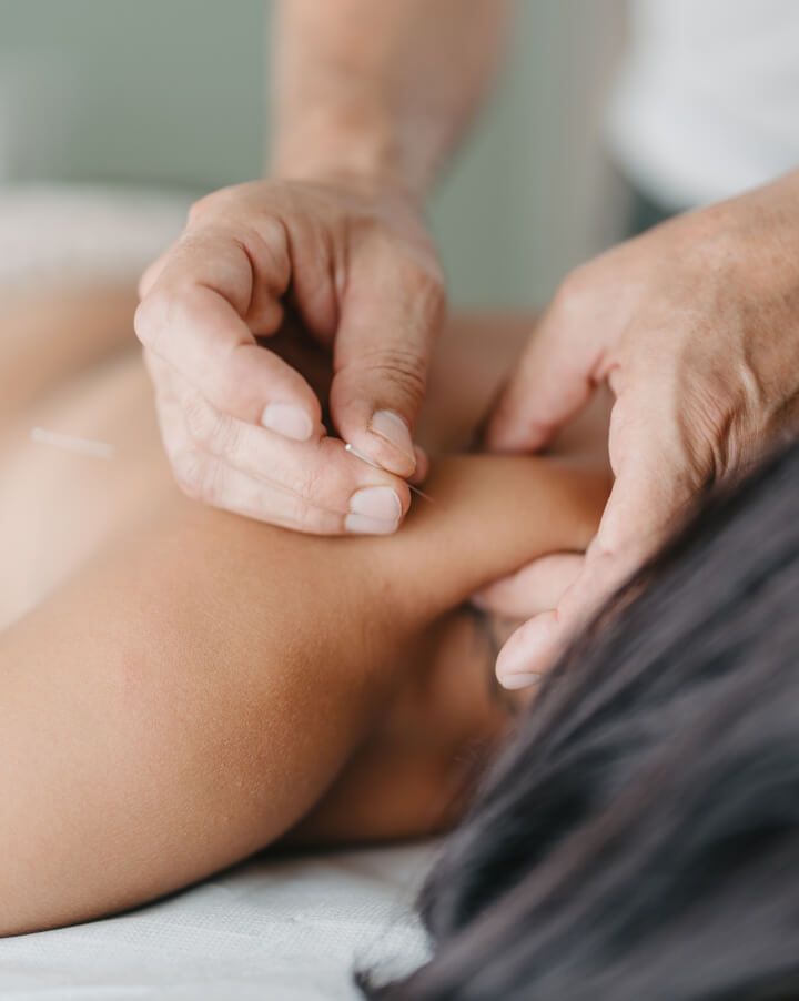 acupuncture
