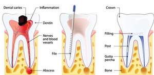 Root Canal Treatment Costs And Procedure