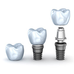 Illustration of dental implant