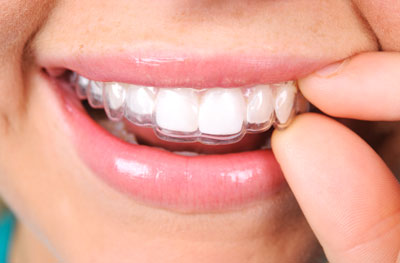 teeth aligners in mouth