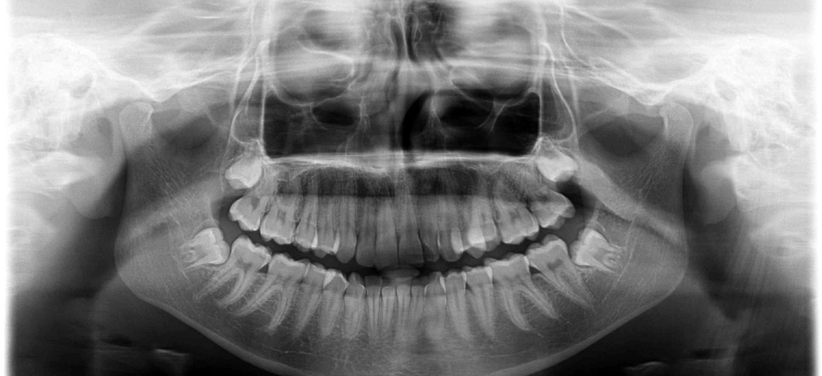 x-ray of patients mouth