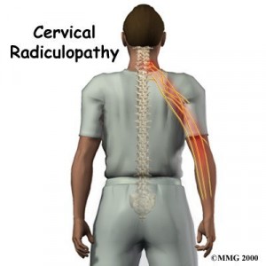 cervical_radiculopathy_intro01