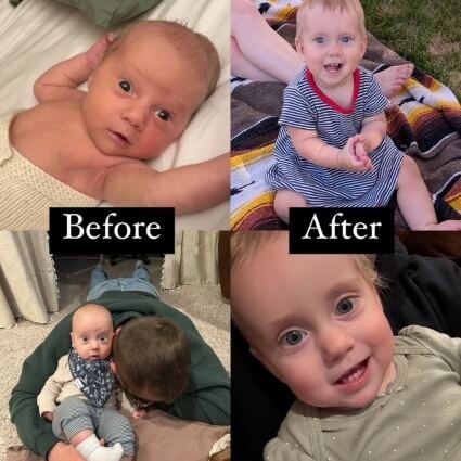 before and after of pediatric patient