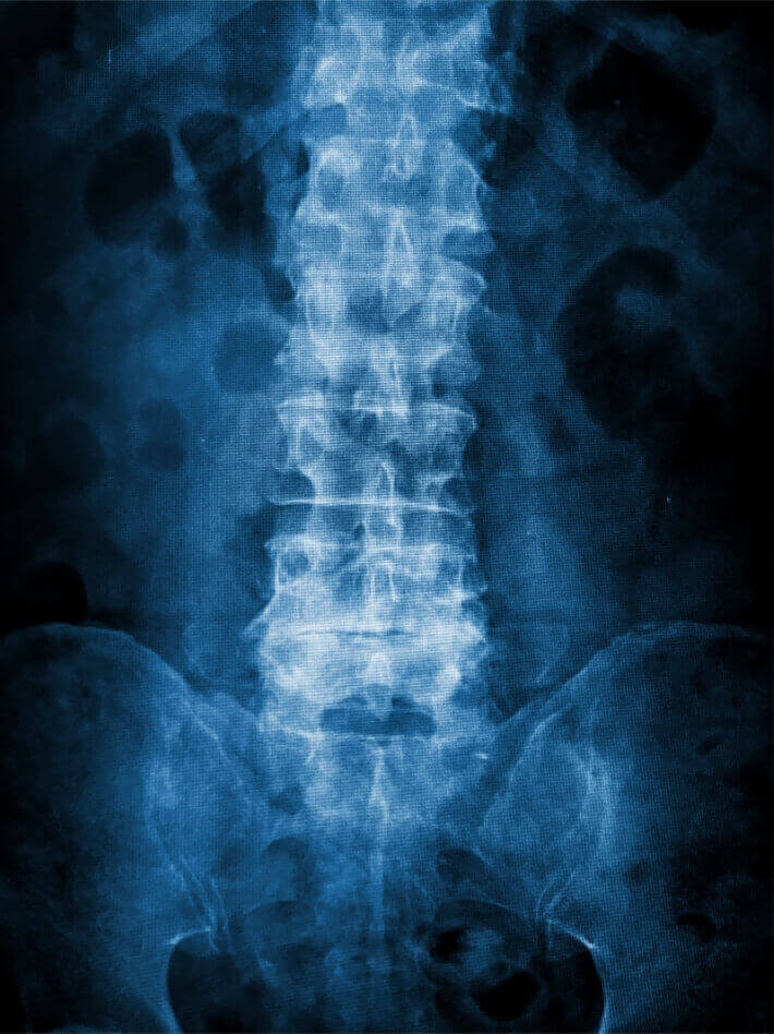 x-ray of a spine