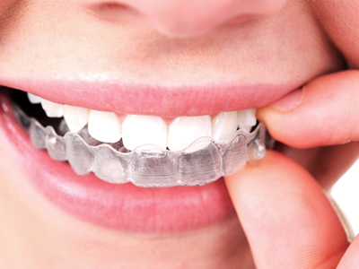 invisalign aligners