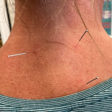 acupuncture treatment