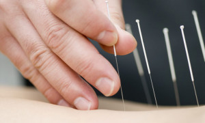 thumbnail_acupuncture