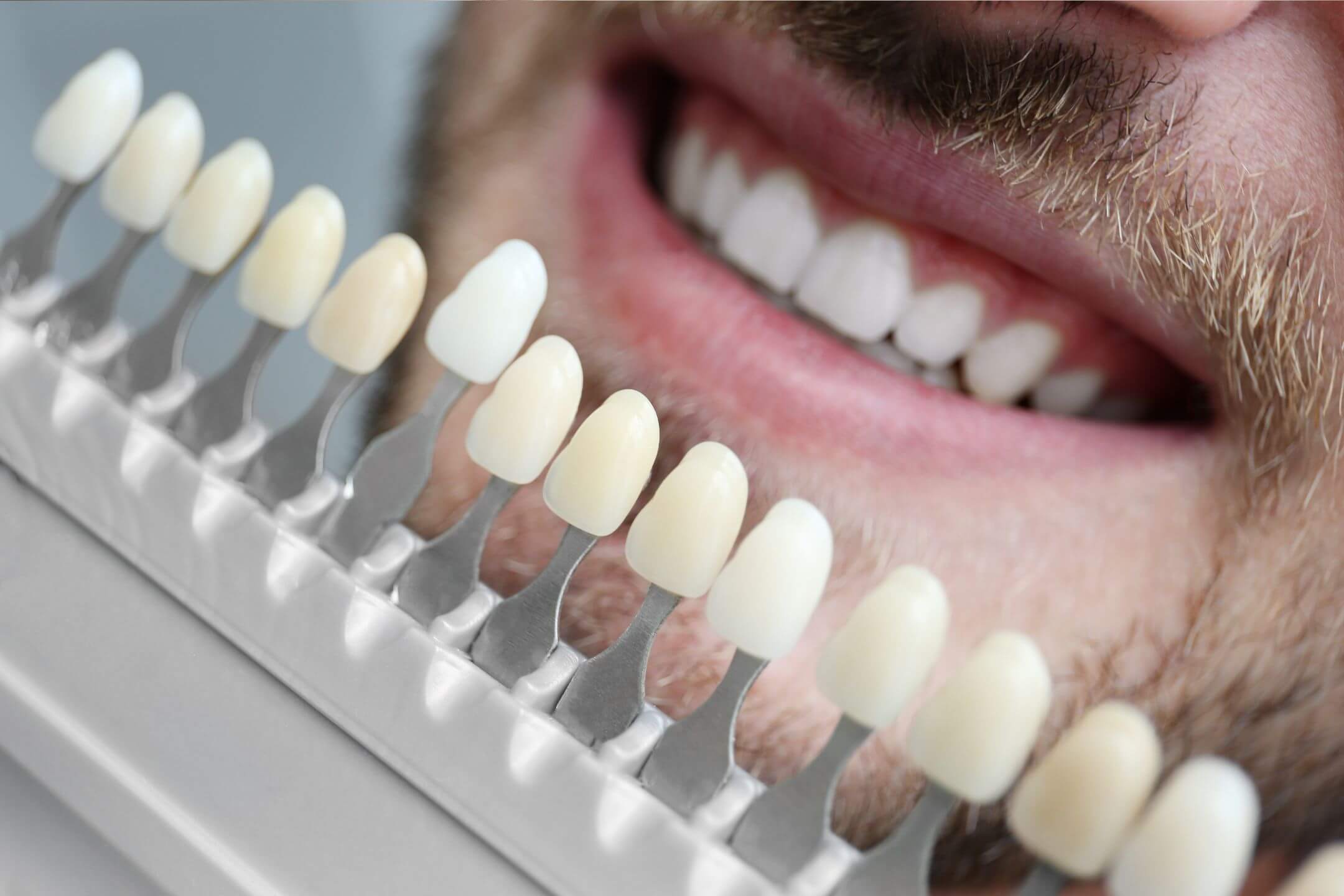 teeth whitening 
