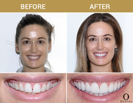 Invisalign Before and After Case Study 9