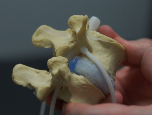 Disc Herniation Model